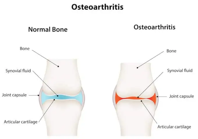 Photo of osteoarthritis - oils for arthritis.