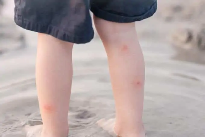 Photo of toddler with bug bites - essential oils for bites.